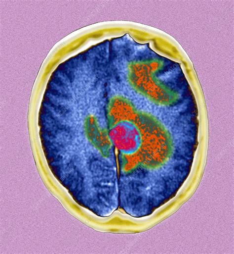 Secondary Brain Cancers Ct Scan Stock Image M1340551 Science