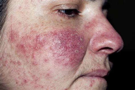 Patch Testing Beneficial In Rosacea To Detect Contact Sensitivity