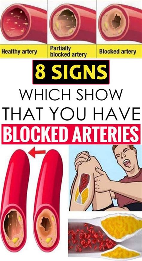 Here Are 8 Warning Signs You Have Blocked Arteries In 2020 Arteries