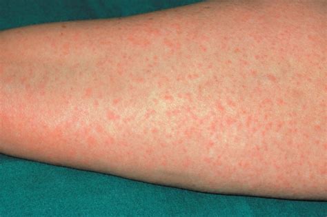 How Long Does A Drug Reaction Rash Last Allergy Differences