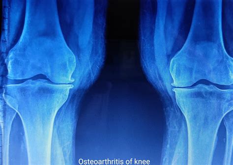 Arthritis Part 2 Osteoarthritis Signs And Symptoms Dr K P V Rao