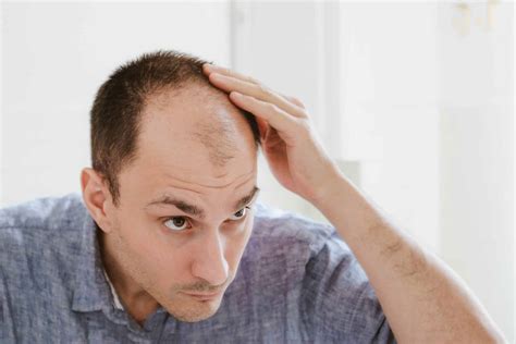 The Stages Of Balding And Treatment Options Aventus Clinic