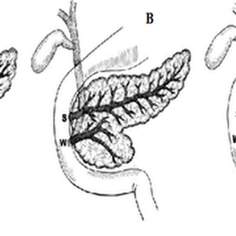 Congenital Abnormalities Pancreas Radiology Imaging
