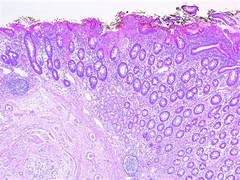 Umbilical Mucosal Polyp Journal Of Clinical Pathology