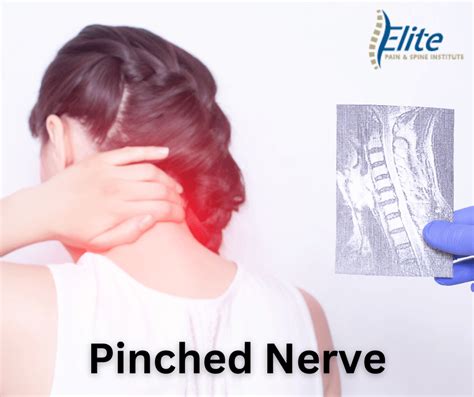 Pinched Nerve All You Need To Know Epsi