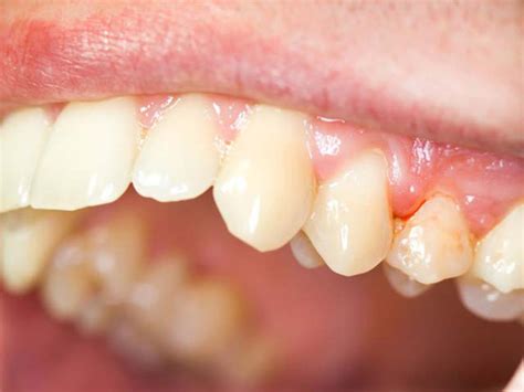 Behandlung Von Zysten Am Zahnfleisch Empfehlungen Zur Entfernung Von
