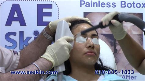 Forever Young Bbl Ipl Photofacial Demonstration 11 A E