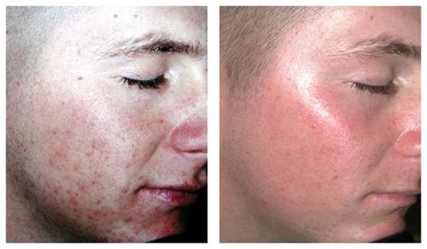 Laser Treatment For Acne And Acne Scarring Complexions Med Spa