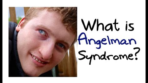 Angelman Syndrome Physical Features