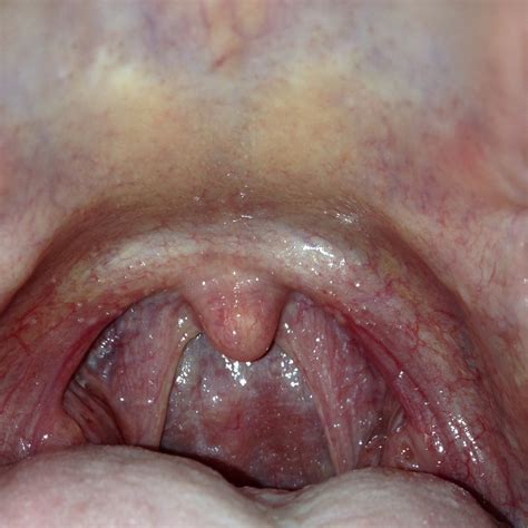Bump on roof of mouth could also indicate mucocele, which is marked by a lump that looks like a cyst but is usually harmless. Condyline