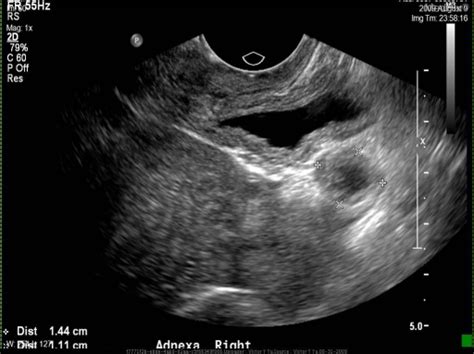 Ultrasound Of Right Adnexa Measuring Abnormal Mass Open I My Xxx Hot Girl