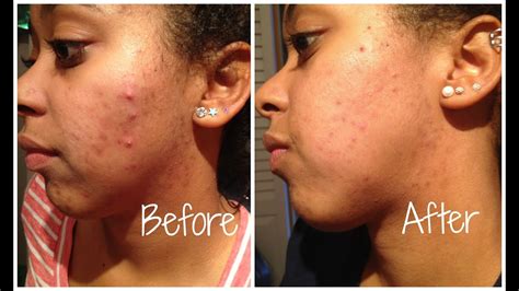 How I Got Rid Off My Acne Before And After Pics At The End Please