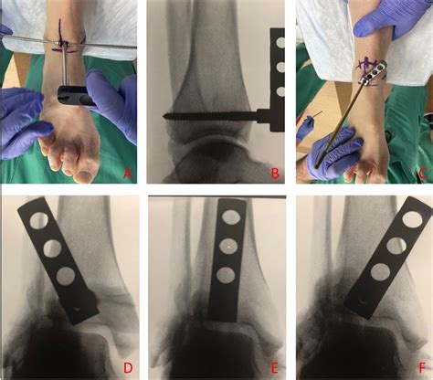 Soft Tissue Structures At Risk With A Percutaneous Focal Dome Osteotomy