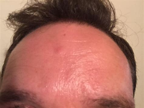 Advice Requested For Long Term Sebaceous Cyst On Forehead