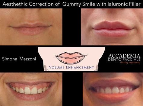 The fantastic news however, is that there are effective treatments and solutions, and to help prove this point, we'll now be taking a look at a few simple and effective ways to fix a gummy smile once and for all. Aesthethic Correction of Gummy Smile with Ialuronic Filler ...
