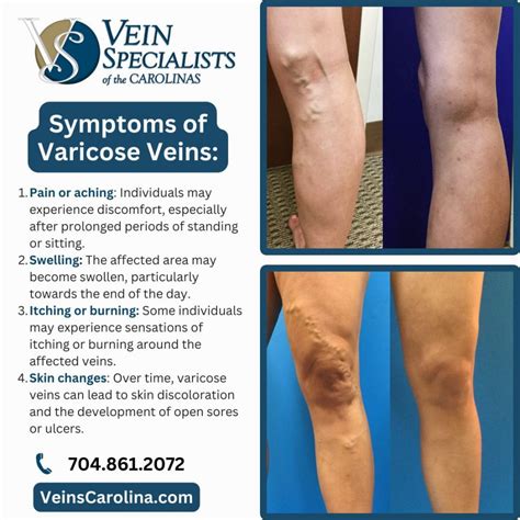 Understanding Varicose Vein Problems 5 Common Symptoms Vein