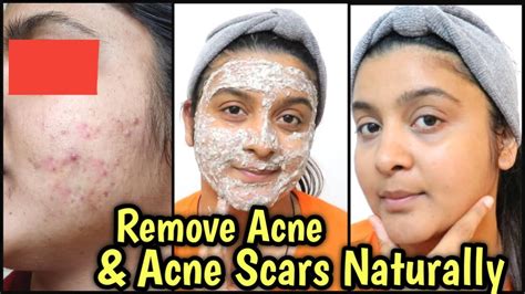 Remove Acne And Acne Scars Naturally At Homebest Home Remedy For Acne