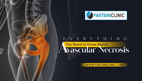 Everything You Need To Know About Avascular Necrosis
