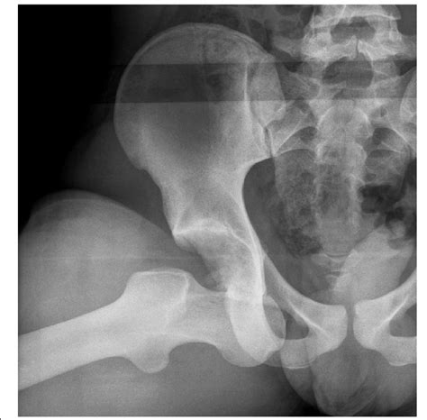 Pelvic Radiograph Picture Showing An Obturator Hip Dislocation With A