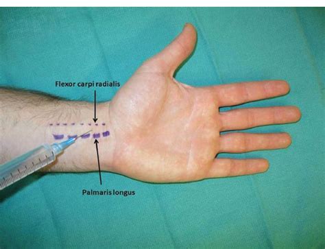 Nerve Block For Hand Surgery 2023 Orthofixar
