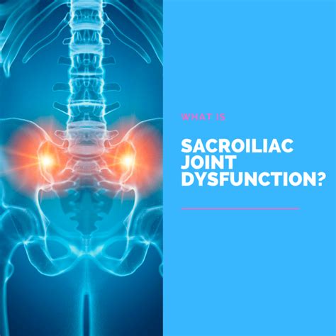 What Is Sacroiliac Joint Dysfunction New Jersey Comprehensive Spine Care