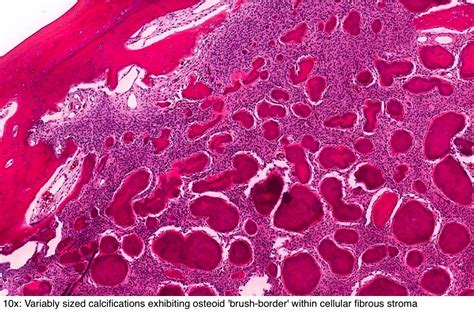 Pathology Outlines Cemento Ossifying Fibroma Ossifying Fibroma