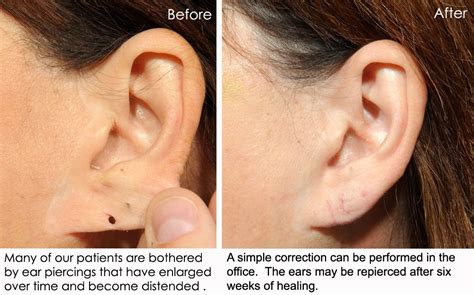 San Diego Earlobe Repair And Mole Removal San Diego Mole Removal Doctor