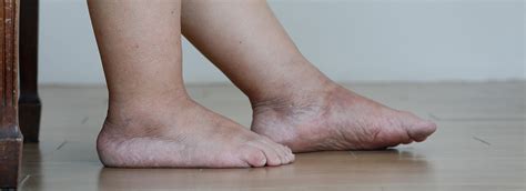 Diabetes Swollen Feet Causes And Treatments