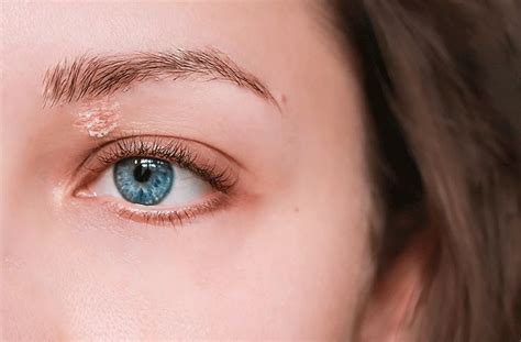 Eyelid Psoriasis All About Vision