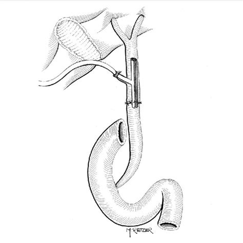 Transverse Choledochotomy And The Insertion Of The Gauze Plug In The