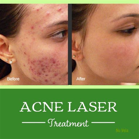 Pin On Acne And Acne Scars Laser Treatment
