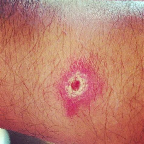 Do You Have A Spider Bite These 7 Photos Can Help You Tell Pulse Ghana