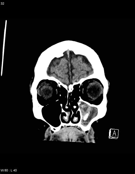 Image | Radiopaedia.org