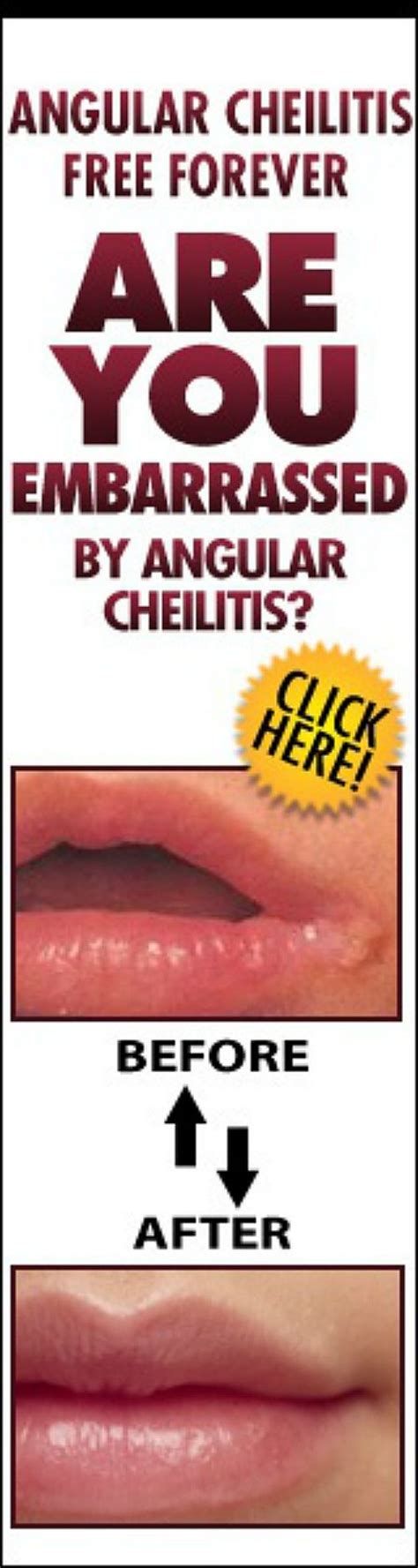 Angular Cheilitis Free Foreverthe Most Effective Angular Cheilitis