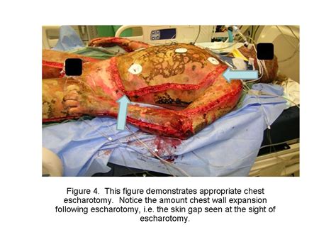 With proper escharotomy, the incision immediately bulges wide open as the pressure is relieved; Conference Notes 6-4-2014 — ACMC EM