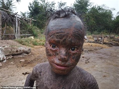 Ten Year Old Boy Dubbed Human Snake Because Condition Causes His Skin