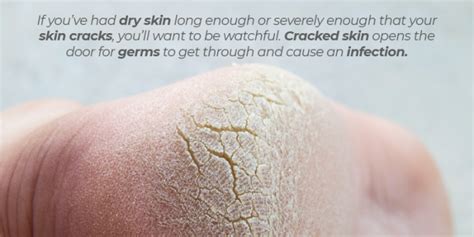 How To Help Dry Skin Delta 5®
