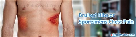 Bruised Ribs Or Sportsmens Chest Paincausesrisk Factorssymptoms