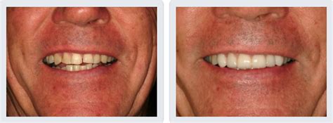 Composite veneers are typically charged around $200 or more, considering it's the cheapest veneer procedure on can avail. Porcelain Veneers Cost in Scottsdale Phoenix AZ