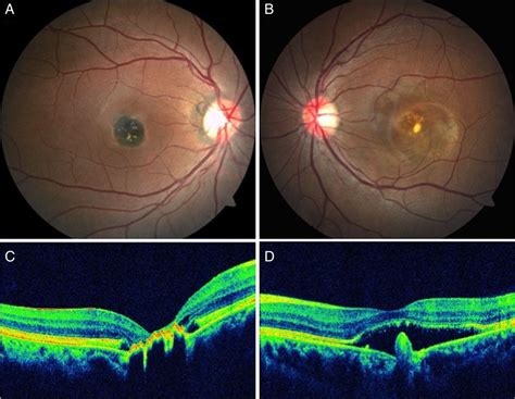 Macular Congenital Hypertrophy Of Retinal Pigment Epithelium Chrpe In