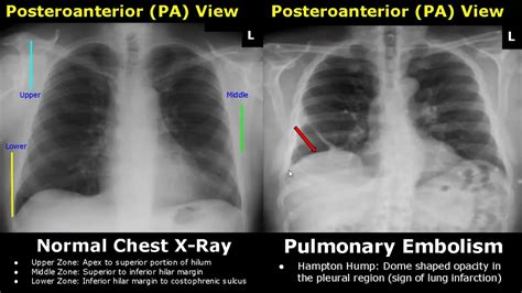 Chest X Ray Lung Normal Vs Abnormal Image Appearances Part 2 Pleural