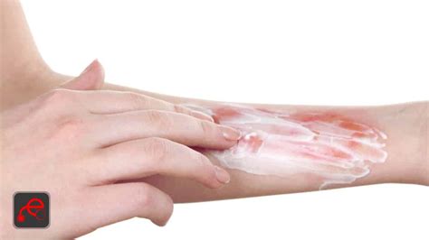 Burn Wounds Types Symptoms And Treatments Easy Medicalogy