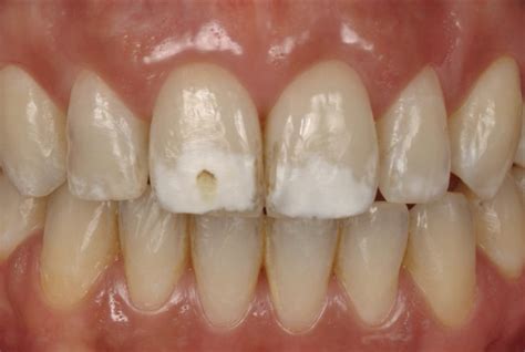 Icon To Remove White Spots And Caries Products