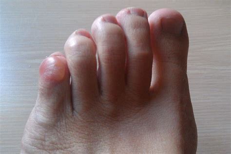 Pinky Toe Blisters Causes And How To Prevent Toe Blister Pinky Toe