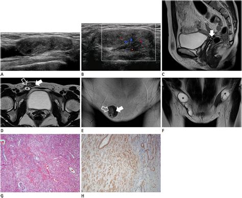 Complete Androgen Insensitivity Syndrome With Paratesticular Leiomyoma A Case Report