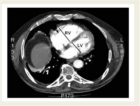 Figure 1 From Multidetector Computed Tomography For Acute Pulmonary