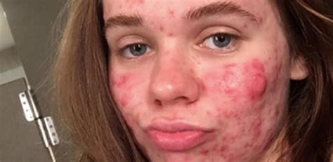 How To Clear Up Cystic Acne According To Top Dermatologist