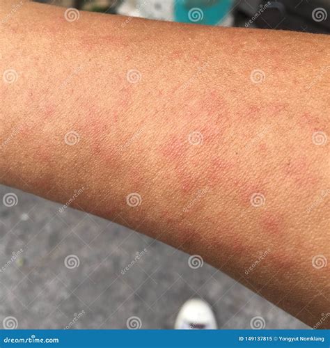 Rash Caused By Skin Allergic To Sweat Dust And Viruses Stock Image