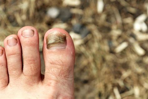 Recently due to our busy schedules, we have been unable to meet/chat as often. Black Toenail - FIND Out More About YOUR Black Toenail TODAY!!