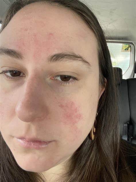 Redness Every Since I Started Wearing Masks My Left Side Of My Cheek